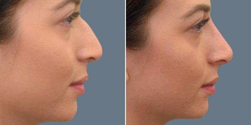 Face Non Surgical Nose Reshape Female Pre2024 008 Before And After