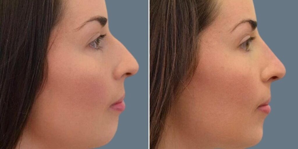Face Non Surgical Nose Reshape Female Pre2024 009 Before And After