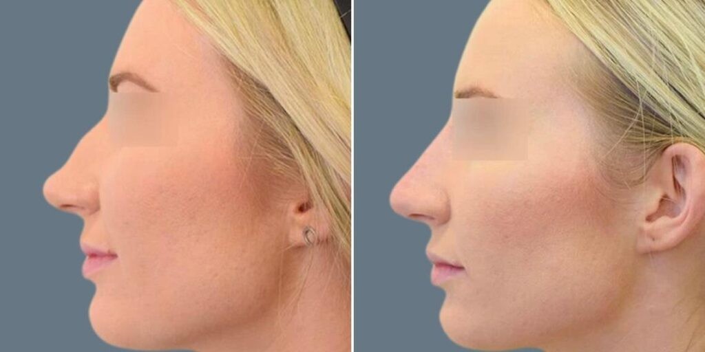 Face Non Surgical Nose Reshape Female Pre2024 010 Before And After