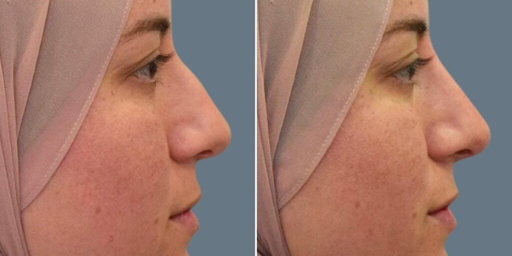 Face Non Surgical Nose Reshape Female Pre2024 011 Before And After