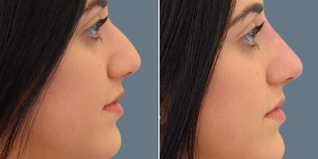 Face Non Surgical Nose Reshape Female Pre2024 012 Before And After