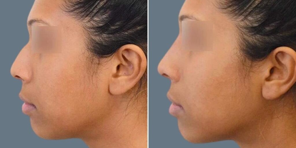 Face Non Surgical Nose Reshape Female Pre2024 013 Before And After