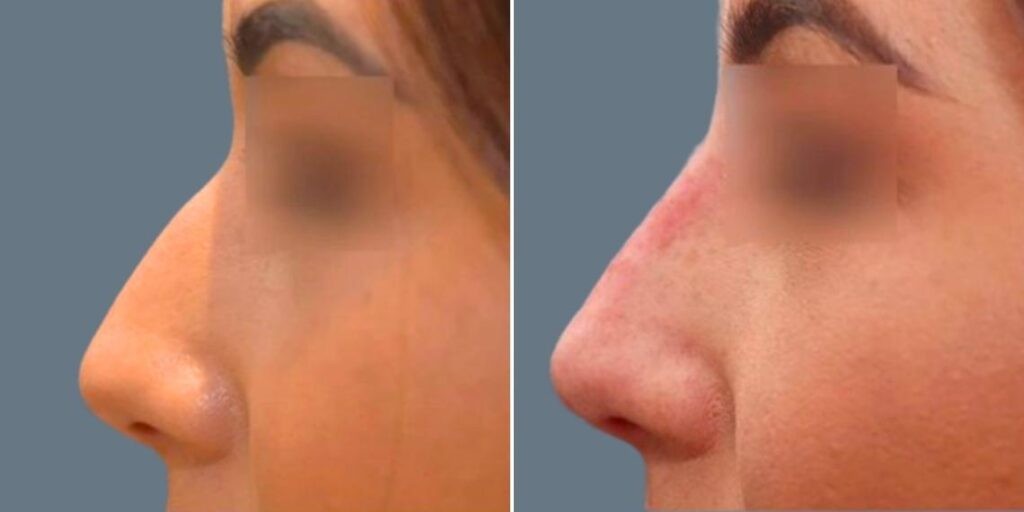 Face Non Surgical Nose Reshape Female Pre2024 014 Before And After