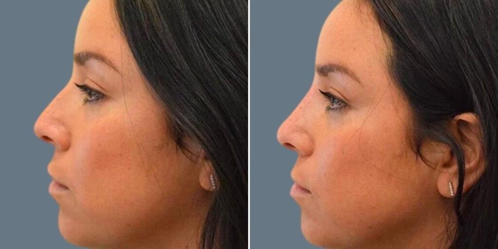 Face Non Surgical Nose Reshape Female Pre2024 015 Before And After