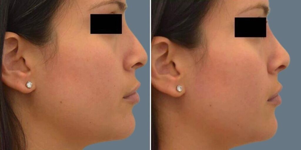 Face Non Surgical Nose Reshape Female Pre2024 016 Before And After