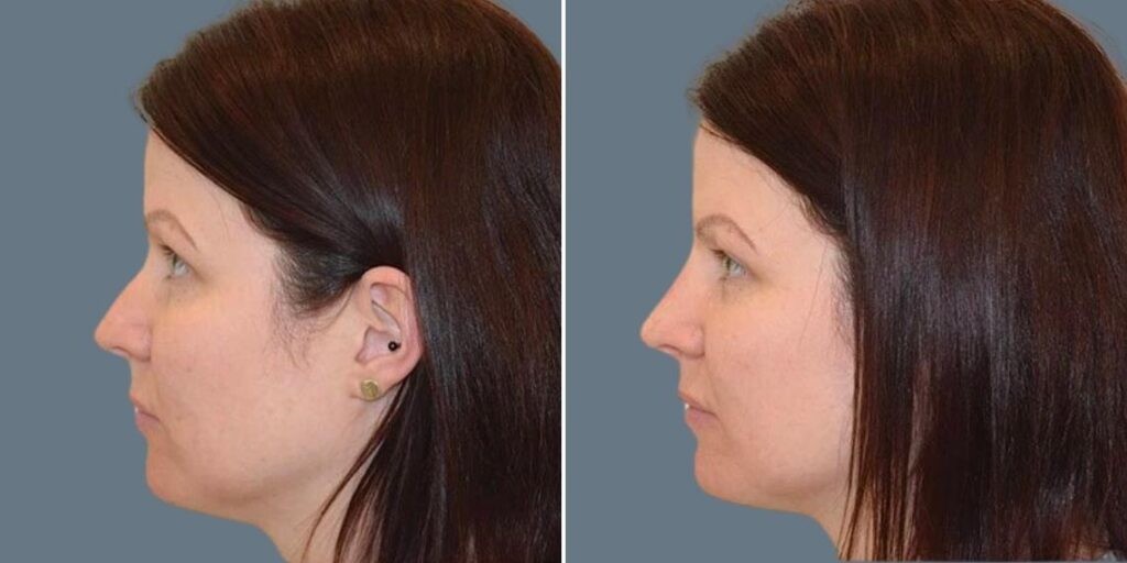 Face Non Surgical Nose Reshape Female Pre2024 017 Before And After