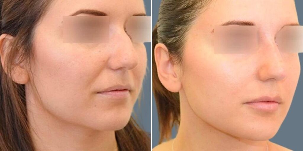 Face Non Surgical Nose Reshape Female Pre2024 018 Before And After