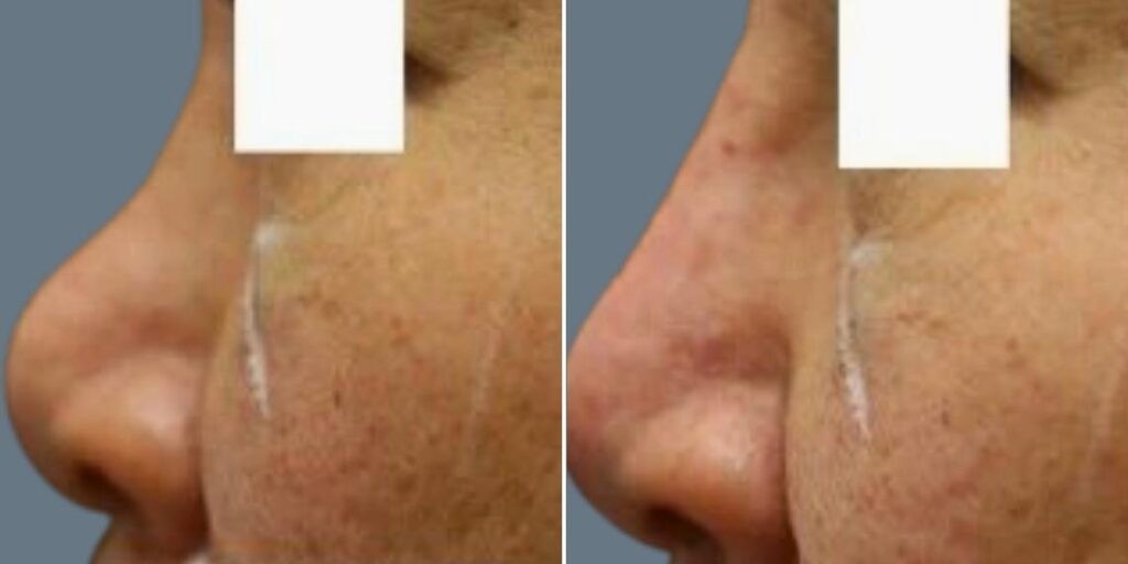 Face Non Surgical Nose Reshape Female Pre2024 019 Before And After