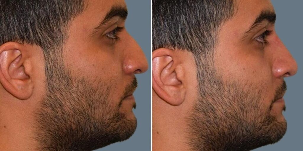 Face Non Surgical Nose Reshape Male Pre2024 002 Before And After