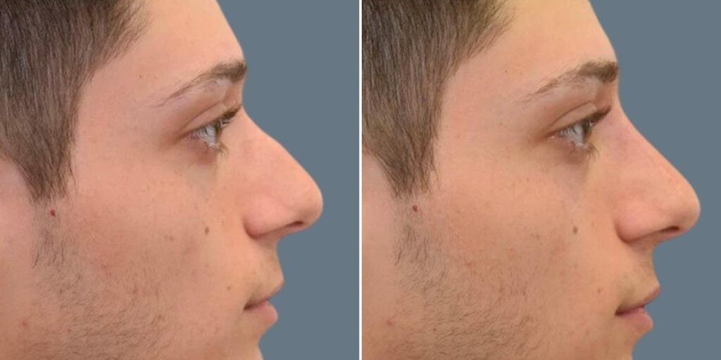 Face Non Surgical Nose Reshape Male Pre2024 004 Before And After