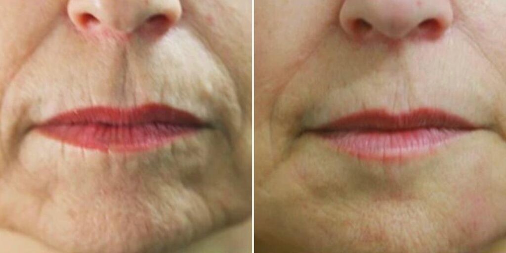 Face Smokers Wrinkles Lift Female Pre2024 001 Before And After