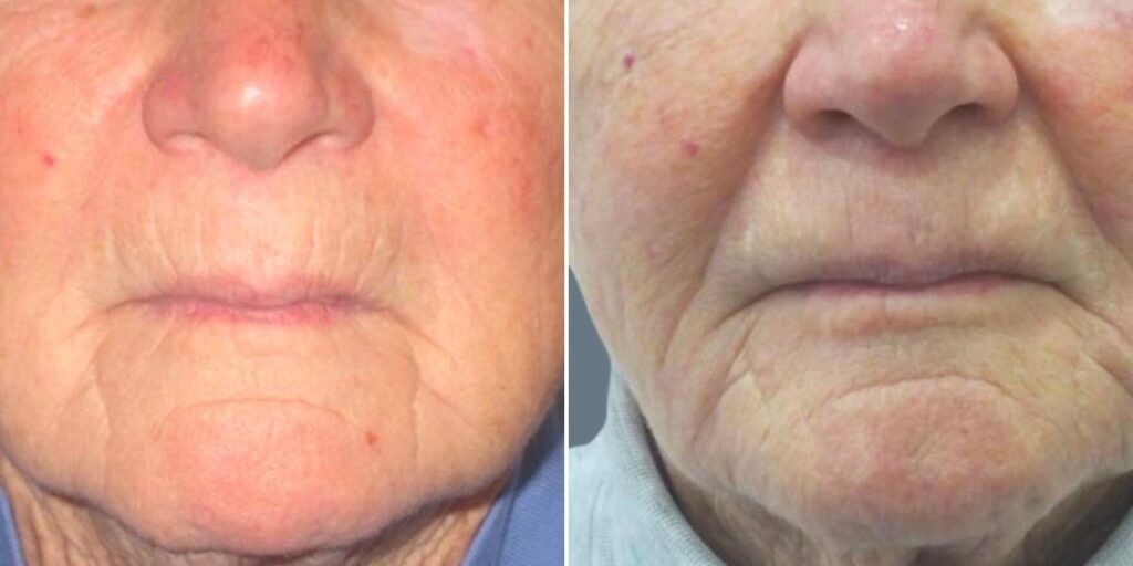Face Smokers Wrinkles Lift Female Pre2024 002 Before And After
