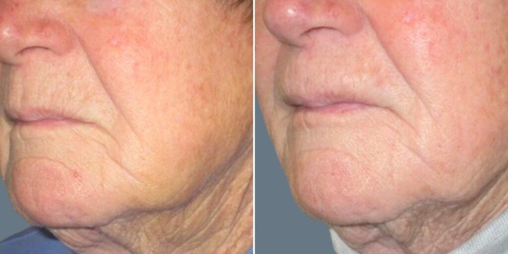 Face Smokers Wrinkles Lift Female Pre2024 003 Before And After