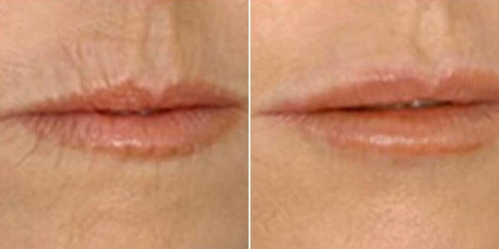 Face Smokers Wrinkles Lift Female Pre2024 004 Before And After