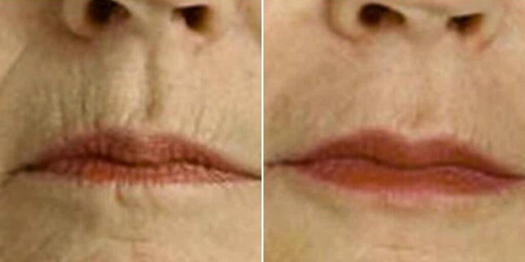 Face Smokers Wrinkles Lift Female Pre2024 005 Before And After