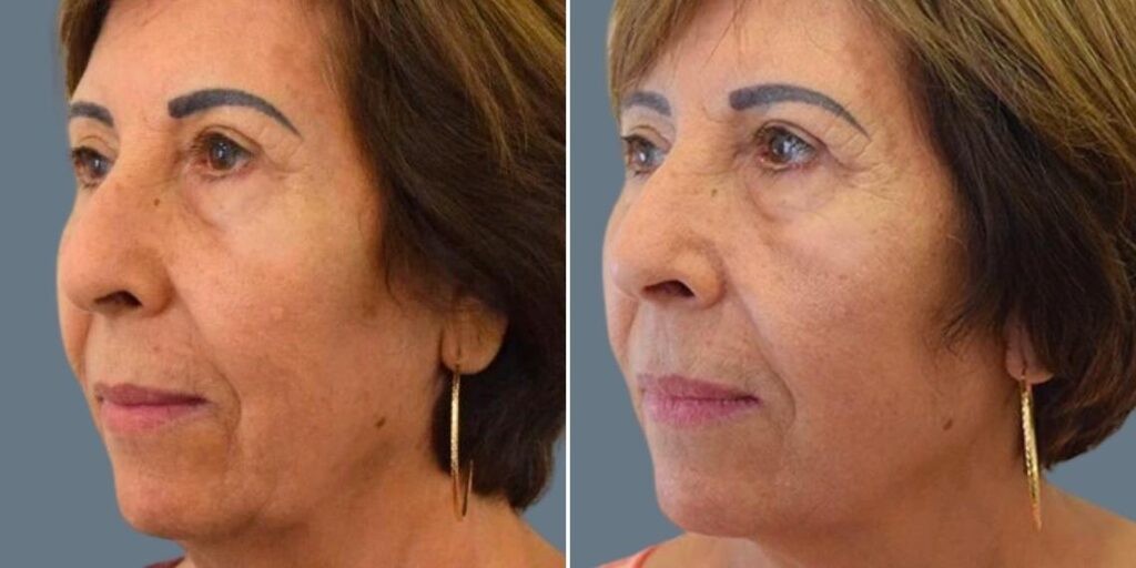Face Ultraformer Female Pre2024 001 Before And After