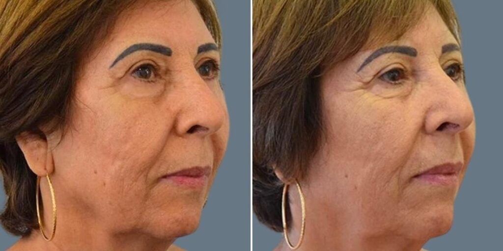 Face Ultraformer Female Pre2024 002 Before And After