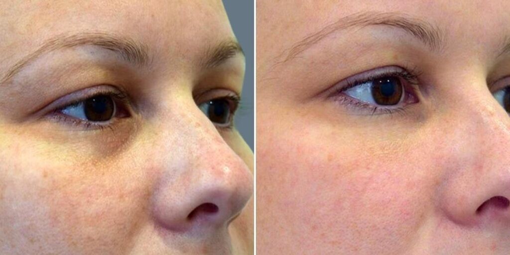 Face Under Eyes Female Pre2024 001 Before And After
