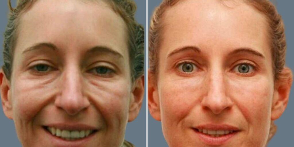 Face Under Eyes Female Pre2024 002 Before And After