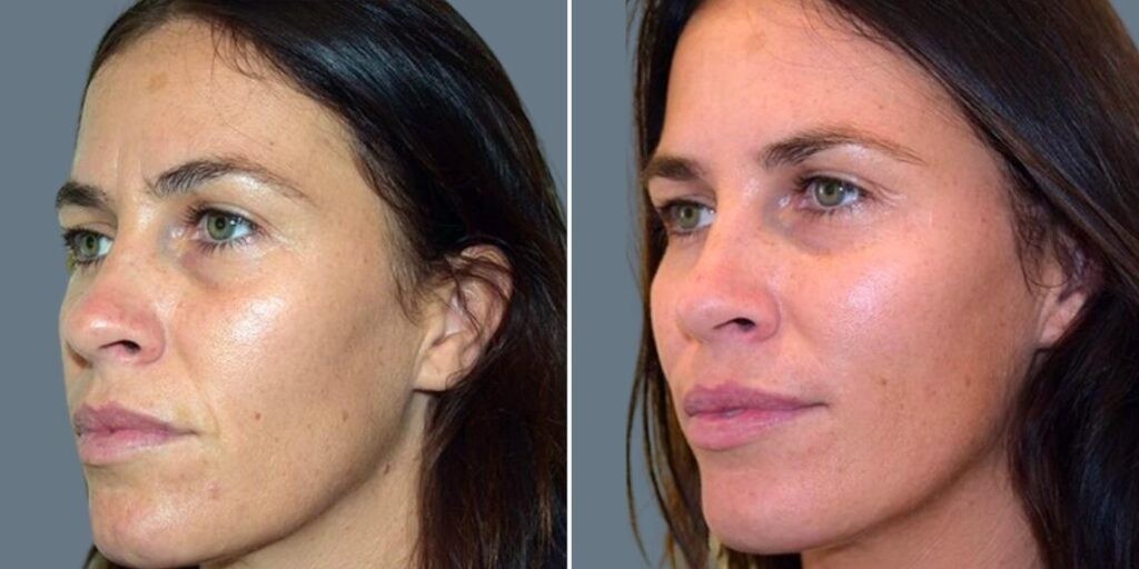 Face Under Eyes Female Pre2024 003 Before And After