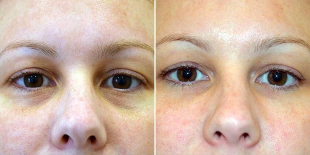 Face Under Eyes Female Pre2024 004 Before And After