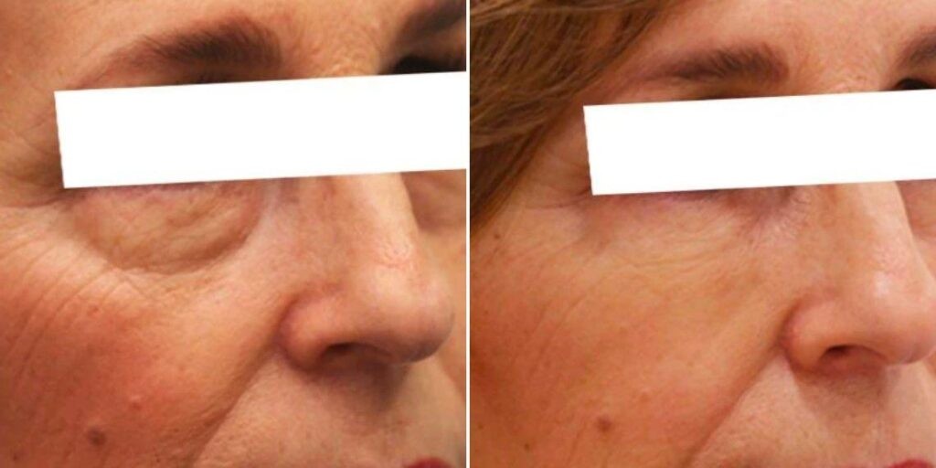 Face Under Eyes Female Pre2024 005 Before And After