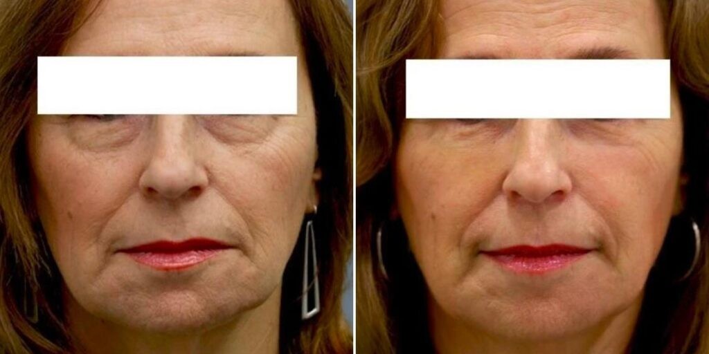 Face Under Eyes Female Pre2024 006 Before And After