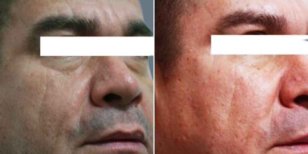 Face Under Eyes Male Pre2024 007 Before And After