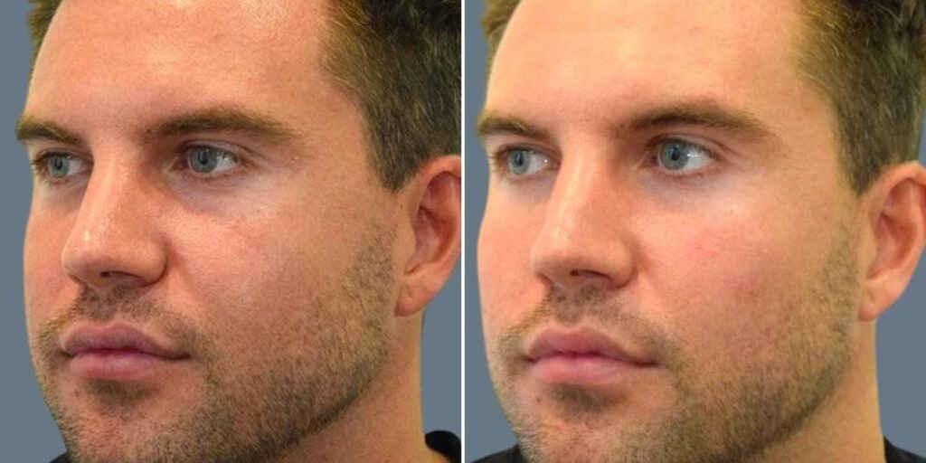 Face Under Eyes Male Pre2024 008 Before And After