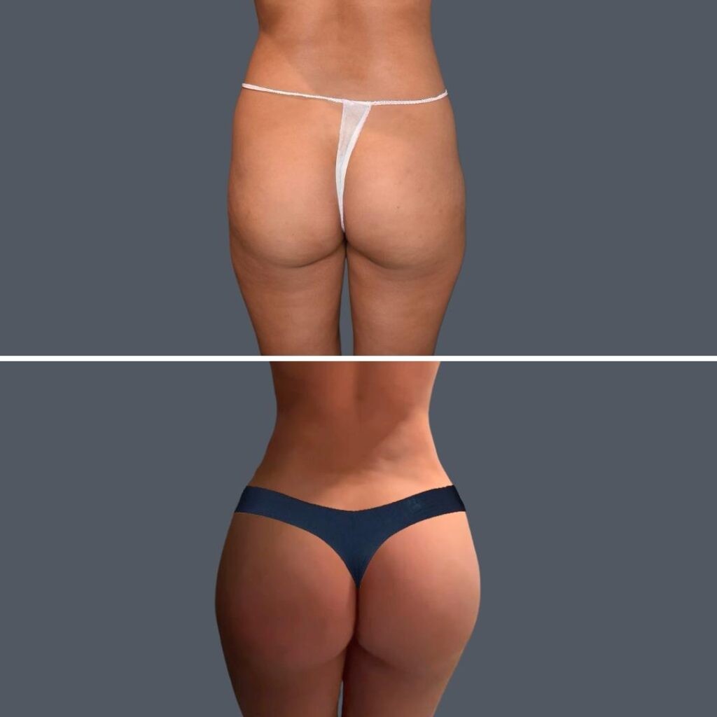 Gold Coast Bbl Liposuction Female 2024 001 Before And After