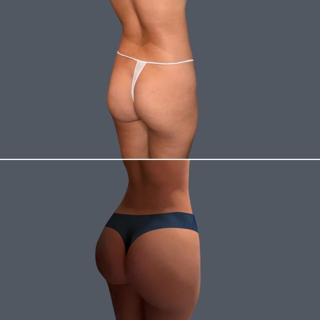 Gold Coast Bbl Liposuction Female 2024 002 Before And After