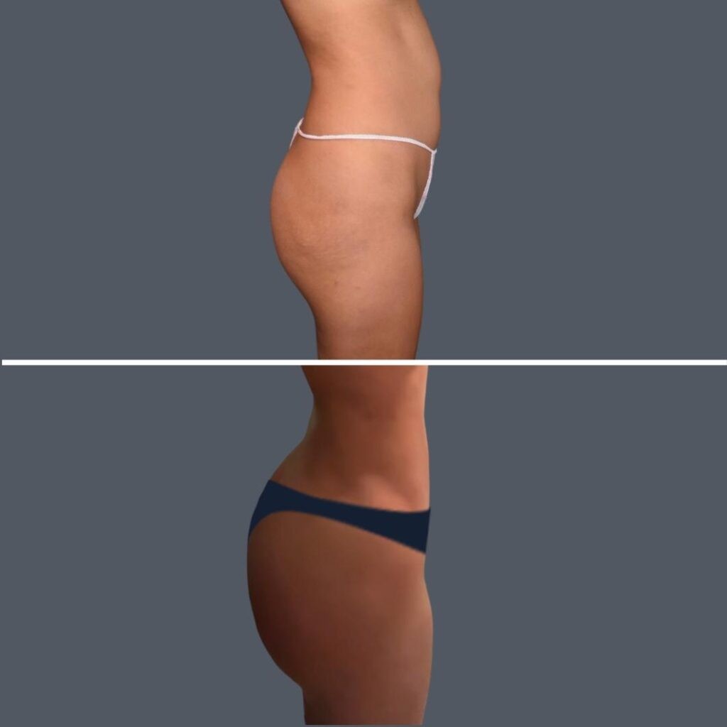 Gold Coast Stomach Liposuction Female 2024 001 Before And After