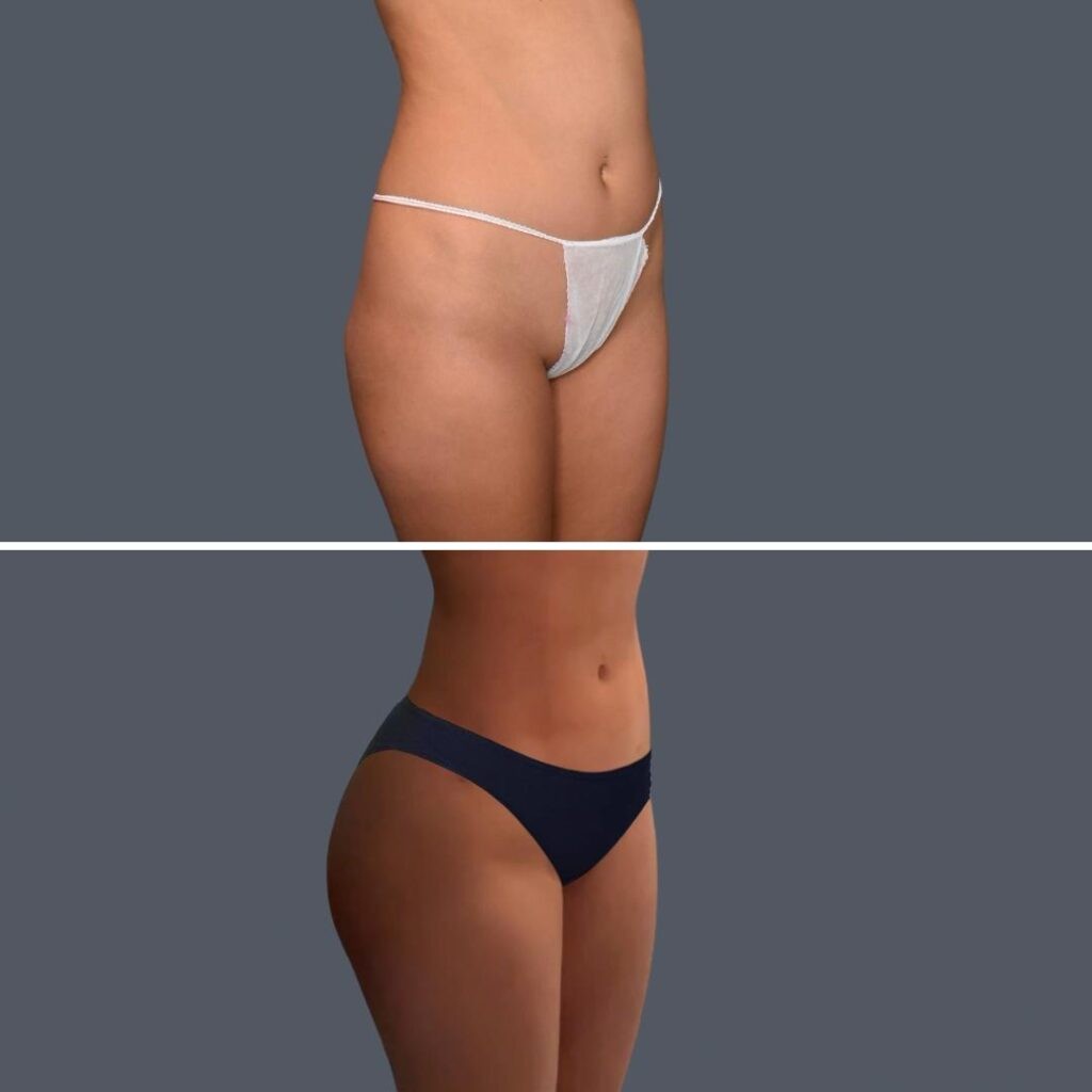 Gold Coast Stomach Liposuction Female 2024 002 Before And After