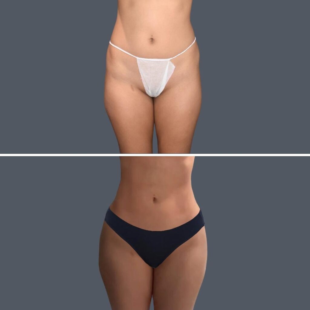 Gold Coast Stomach Liposuction Female 2024 003 Before And After