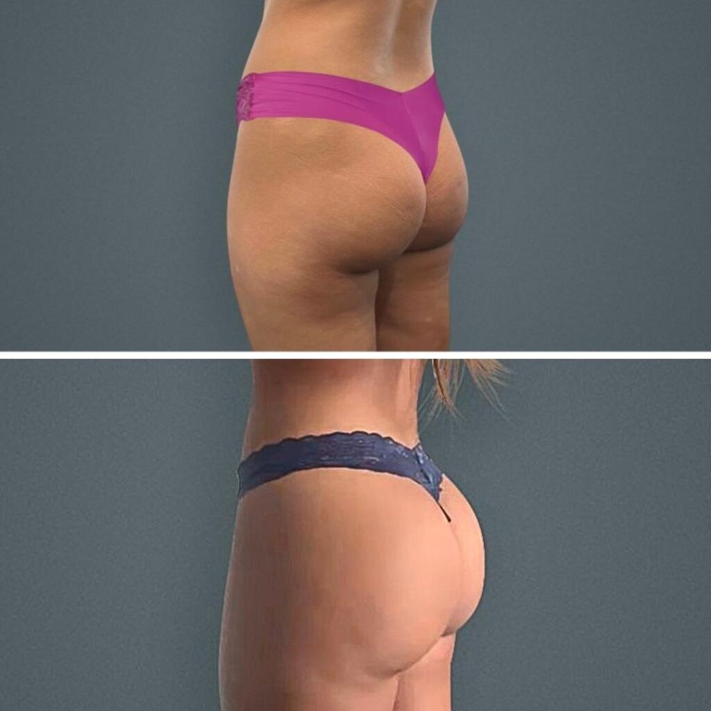 Goldcoast Bbl Butt Female 2023 Left 108 Before And After