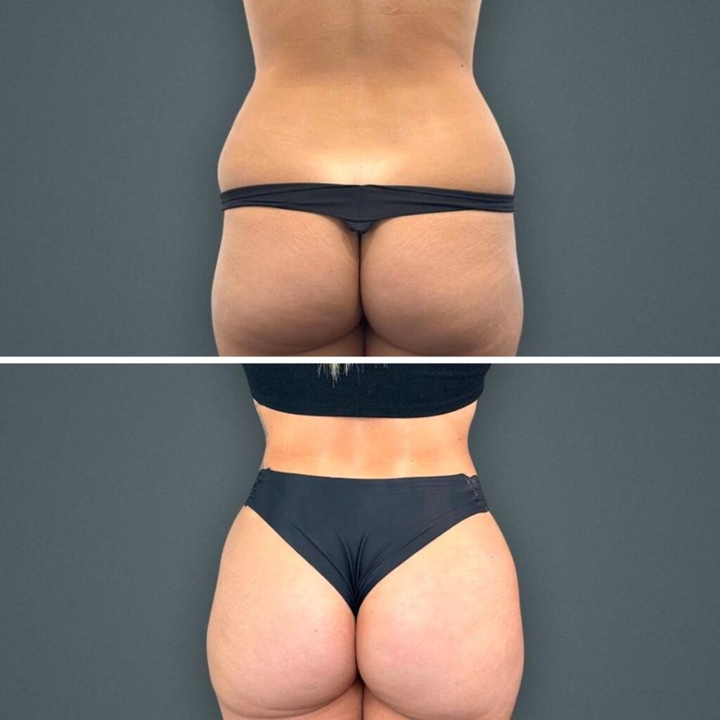 Goldcoast Bbl Butt Female 2023 Rear 111 Before And After