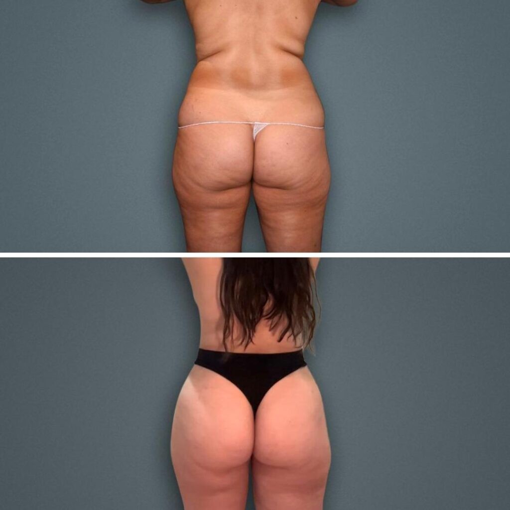 Goldcoast Bbl Butt Female 2023 Rear 115 Before And After