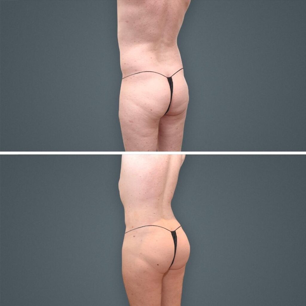 Goldcoast Bbl Butt Male 2023 Left 210 Before And After