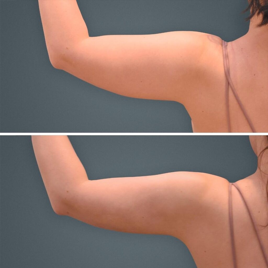 Goldcoast Coolsculpting Arm Female 2023 Rear 200 Before And After