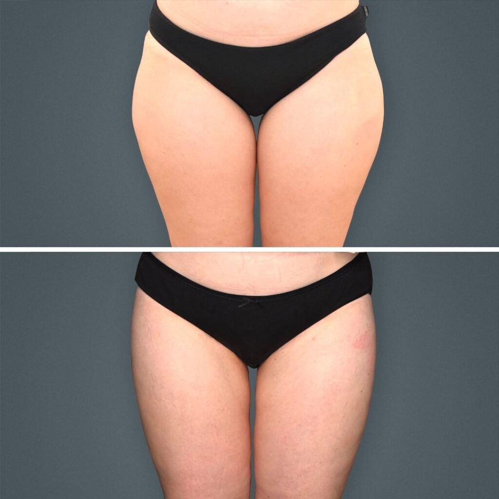 Goldcoast Coolsculpting Legs Female 2023 Front 182 Before And After