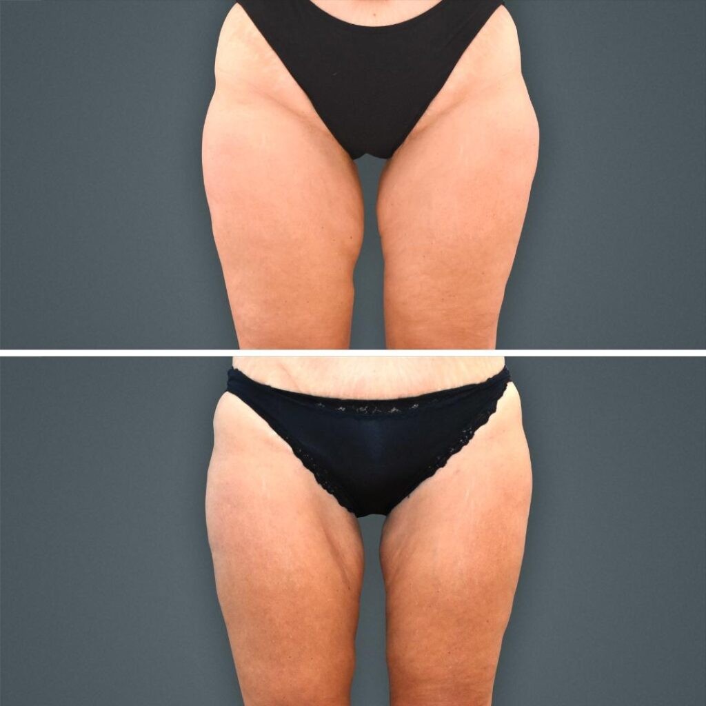 Goldcoast Coolsculpting Legs Female 2023 Front 203 Before And After