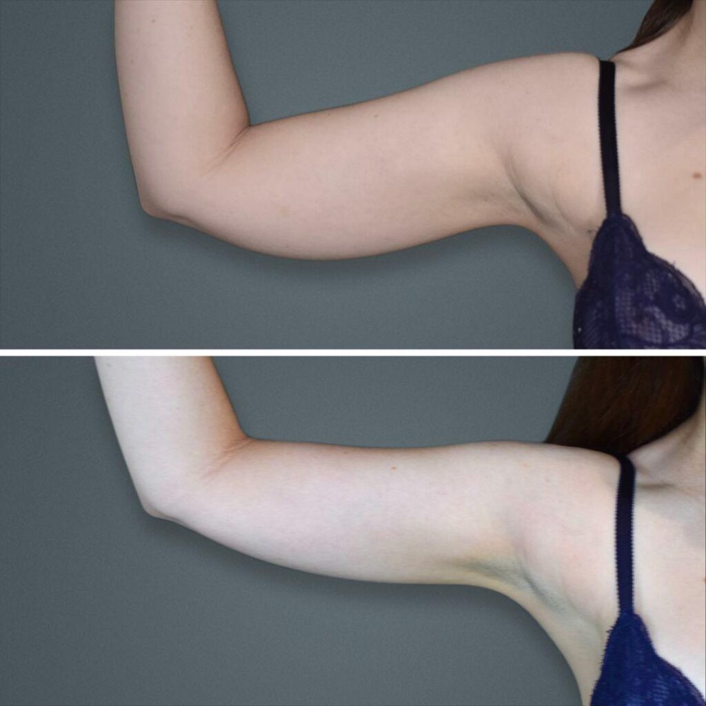 Goldcoast Liposuction Arm Female 2023 Right 101 Before And After