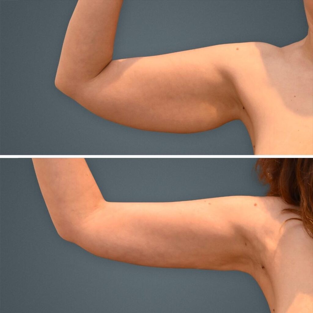 Goldcoast Liposuction Arm Female 2023 Right 171 Before And After