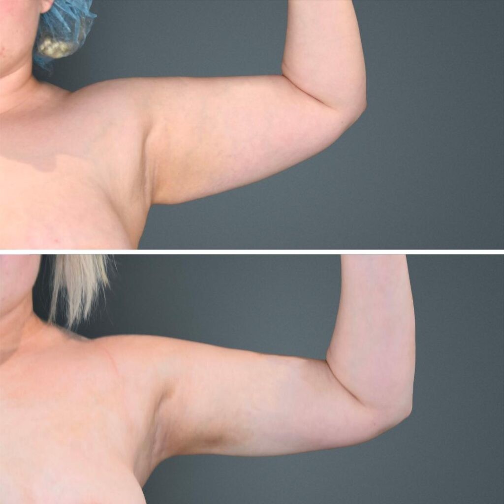 Goldcoast Liposuction Arm Female 2023 Right 214 Before And After