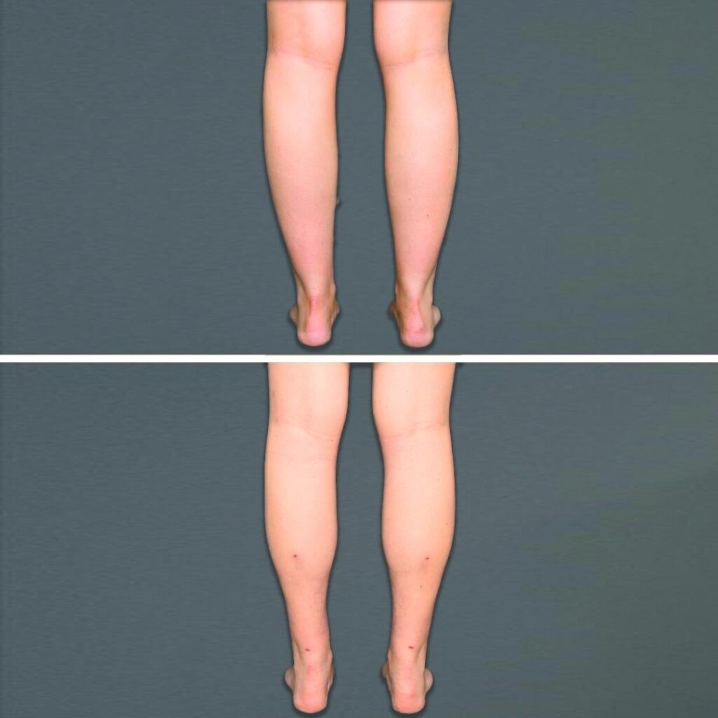 Goldcoast Liposuction Calf Female 2022 Rear 68 Before And After