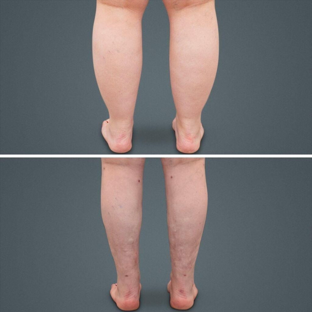 Goldcoast Liposuction Calf Female 2023 Rear 144 Before And After