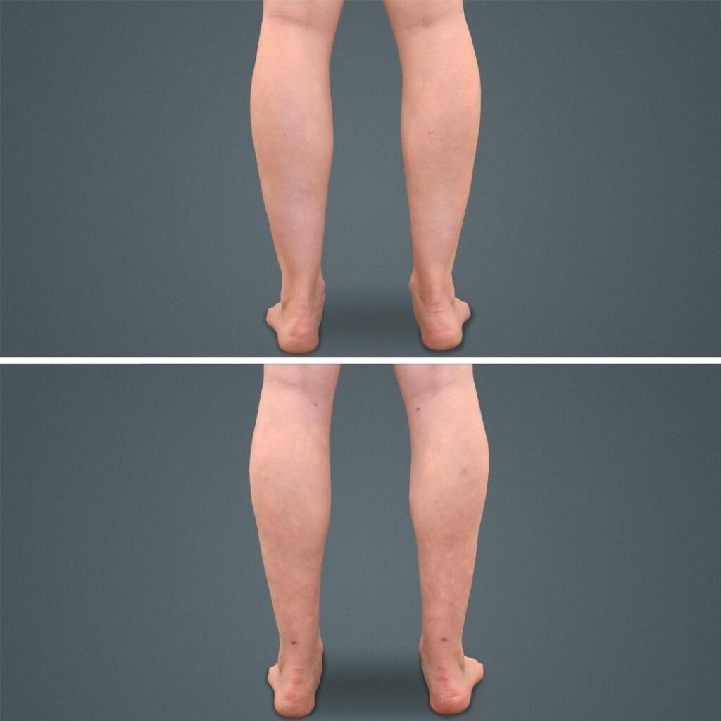 Goldcoast Liposuction Calf Female 2023 Rear 156 Before And After