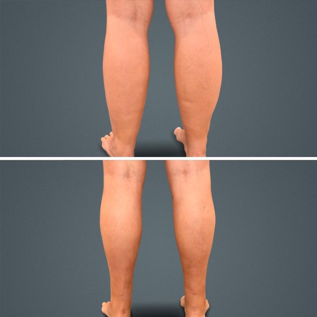 Goldcoast Liposuction Calf Female 2023 Rear 161 Before And After