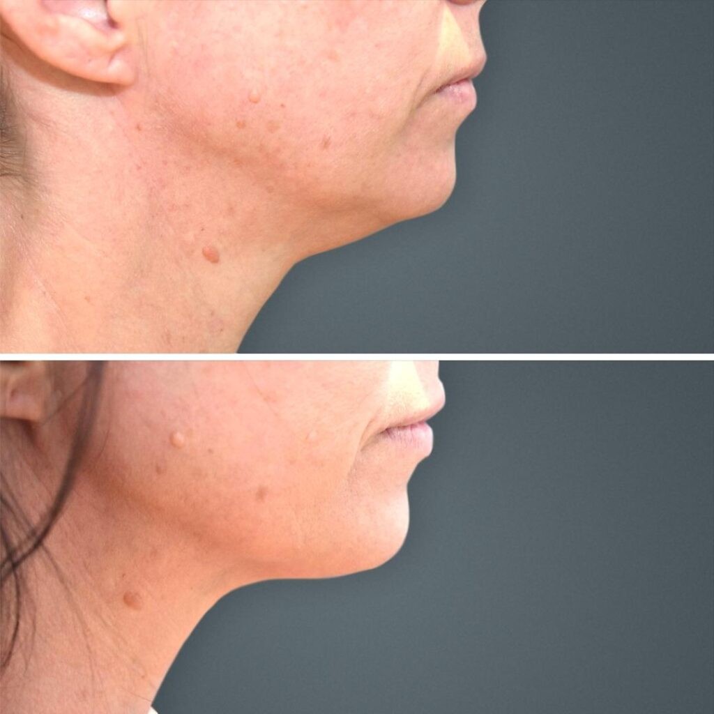 Goldcoast Liposuction Face Female 2023 Left 174 Before And After