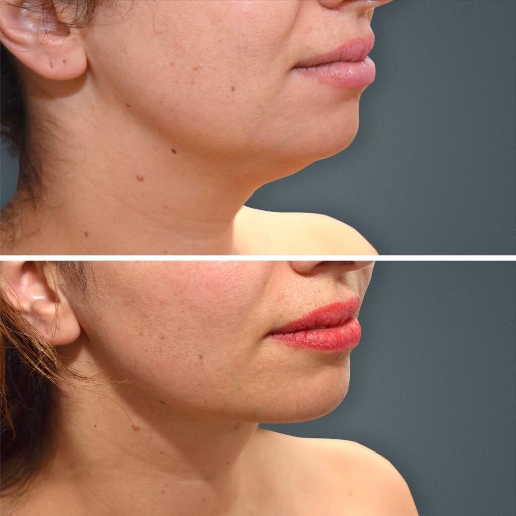 Goldcoast Liposuction Face Female 2023 Left 187 Before And After